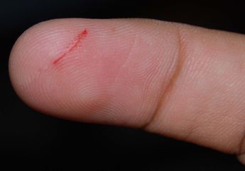 Ada Orang yang Menderita Hemofilia, Penyakit Apa Itu? #AkuBacaAkuTahu