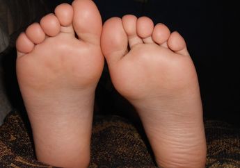 Mata Ikan di Kaki Bisa Menular Tidak, ya? Cari Tahu Penyebabnya, yuk!