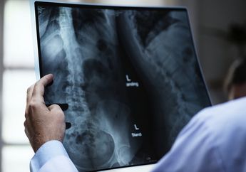Hati-Hati, Osteoporosis yang Banyak Dialami Orang Tua Juga Bisa Dialami Anak-Anak, Ketahui Penyebabnya!