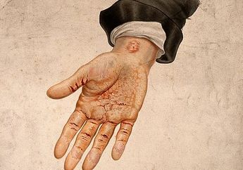 Kondisi Kulit Gatal Psoriasis Bisa Terjadi Pada Anak-Anak, Apa Itu Psoriasis?