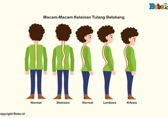 Penjelasan Skoliosis, Lordosis, dan Kifosis yang Merupakan Kelainan pada Tulang Belakang
