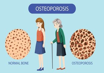 Penyebab dan Cara Pengobatan Osteoporosis