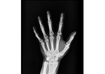 Kenapa Sinar X-Ray Bisa Menembus Benda Padat?