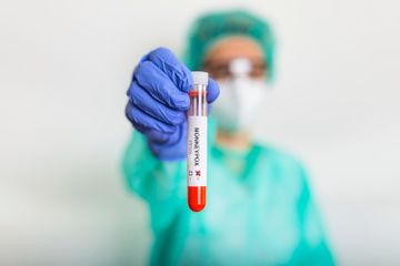 Vaksin Cacar Monyet Belum Tersedia di Indonesia, Berikut Obat untuk Membantu Kondisi Pasien Cacar Monyet