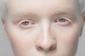 Apa yang Dimaksud dengan Albinisme atau Albino?