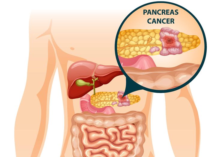 6 Penyakit pada Pankreas dan Gejalanya yang Perlu Diwaspadai - Semua  Halaman - Bobo