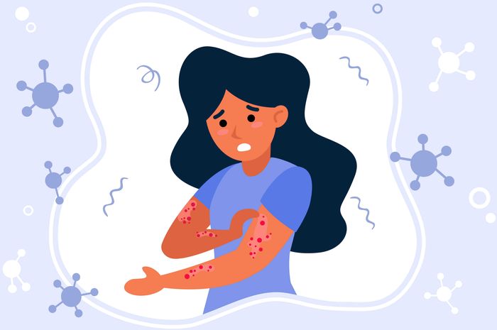 Cacar monyet alias monkeypox adalah penyakit infeksi virus.