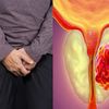 Para Istri Coba Cek, Jika Suami Alami Gejala Ini Tiap Malam, Bisa Jadi Pertanda Kanker Prostat