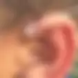 Punya Lubang Kecil Seperti Ini di Telinga? Nggak Perlu Takut, Berikut Penjelasannya