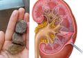 Dokter Keluarkan 56 Batu dari Ginjal Bocah 9 Tahun Ini, Petugas Medis Ungkap 5 Penyebabnya!
