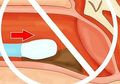 Bahaya Moms, Jangan Pakai Cotton Bud untuk Bersihkan Telinga Si Kecil