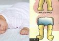 Wah! Ternyata, Tidur Tengkurap Dapat Timbulkan Kelainan Kaki Pada Anak