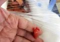 Hebat, Bayi Prematur Terkecil ini Bisa Bertahan, Kepalanya Sebesar Bola Pingpong, Kakinya Lebih Kecil dari Jari Tangan Orang Dewasa