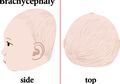 Mengenal Plagiocephaly, Kondisi Kepala Peyang yang Terjadi pada Bayi
