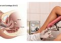 Kuret Namanya Dikenal Prosedurnya Jarang yang Tahu, Padahal Penting Untuk Kesehatan Organ Reproduksi Wanita