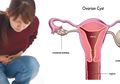 Penyebab Kista pada Wanita, Gejalanya hingga Cara Menghindarinya