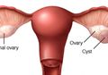 Nyeri Perut Tak Kunjung Sembuh, Ternyata Kista Ovarium Sebesar 18 Kg Tumbuh di Perut Wanita India Ini Sampai Sulit Napas