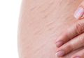 Jangan Salah Perawatan! Ini Cara Efektif Atasi Stretch Mark