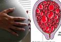 Perempuan dengan Ciri Berikut Berisiko Tinggi Mengalami Hamil Anggur