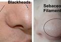Cek! Mirip Komedo Padahal Sebaceous Filaments. Awas, Beda Treatment!