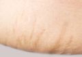 Menghilangkan Stretch Mark Bisa Pakai Gula Pasir, Bagaimana Caranya?