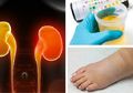 Gagal Ginjal Kronis Bisa Memaksa Kita Transplantasi Ginjal, Hindari Mulai dari Penyebabnya