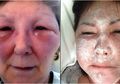 Wajah Wanita Ini Membeku Setelah Suntik Botoks dengan Bantuan Dokter Gadungan!