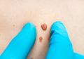 Jangan Hilangkan Skin Tag Tanpa Bantuan Dokter, Bisa Berisiko Fatal