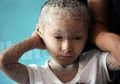 Waspadalah, 1 dari 300 Orang Bisa Menderita Ichthyosis alias Penyakit Kulit Sisik Ikan