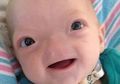Lahir Tanpa Hidung, Bayi Menggemaskan Ini Tetap Tersenyum Manis