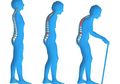 Waspadai! Ternyata Kebiasaan Sehari-hari Ini Bisa Sebabkan Osteoporosis