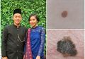 Waahh… Ternyata yang Sering Digunakan Memasak Ini Bisa Jadi Penyebab Kanker Kulit yang Renggut Nyawa Menantu Hatta Rajasa, Hati-hati!