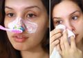 Bebas Rasa Sakit, Youtuber Ini Bagikan Trik Mudah Singkirkan Komedo