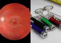 Jangan Sepelekan Pulpen Laser, Mata Anak Ini Berlubang Akibat Bermain Pulpen Laser