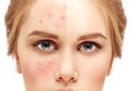 Pilihan Serum untuk Menghilangkan Bekas Jerawat, Brand Lokal Gak Kalah Ampuh!