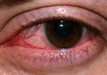 Sempat Viral Foto Mata Merah Karena Pembuluh Darah Pecah Akibat Main Ponsel Saat Tidur, Ini Fakta Sebenarnya