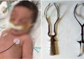 Karena Persalinan Forsep, Kepala Bayi Ini Terputus, Inilah yang Dilakukan Sang Dokter Saat Persalinan!