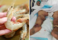 Tergores Kulit Udang, Wanita Ini Alami Infeksi Parah dan Akhirnya Meninggal