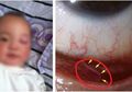 Kok Bisa Mata Anak Usia 2 Tahun Dipenuhi Cacing? Ternyata Ini Sebabnya