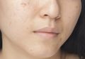 Ini 5 Langkah Skincare yang Tepat Untuk Hilangkan Bekas Jerawat!