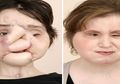 Inilah Transformasi Wajah Katie Stubblefield, si Penerima Transplantasi Wajah dari 7 Orang Lainnya