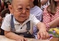 Baru 6 Tahun, Wajah Anak Ini Sudah Kendur Seperti Pria 70-an, Ini Penyebabnya