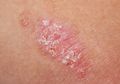 Mengenal Penyakit Kulit Psoriasis, Tidak Menular Tapi Bikin Penderitanya Galau