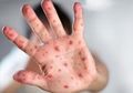 Puluhan Siswa Terkena Rubella, Yuk Moms Cegah dengan Cara Ini!