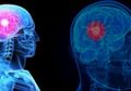 Tak Perlu Bedah Tengkorak, Tumor Otak Kini Bisa Ditangai Melalui Alis & Tak Tinggalkan Bekas Jahitan!
