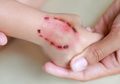 Kematian Akibat Virus Rabies, Sebagian Besar Menyerang Anak-Anak