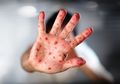 Data Pada 23 Juta Anak Tak Menunjukkan Hubungan Autisme dengan Vaksin MMR
