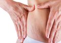 Duh, Tubuh Kebanyakan Stretch Mark? Simak Cara Antisipasinya Berikut!