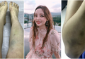 Rilis Foto Memar Sekujur Tubuh, Idola K-Pop Goo Hara Diserang Pacar Hingga Pendarahan Rahim!