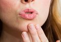 Inilah 5 Cara Mencegah dan Mengobati Bibir Pecah-Pecah, Mudah Banget!
